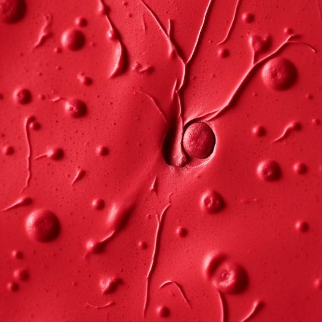 Sickle Cell Disease: Causes, Symptoms, and Management